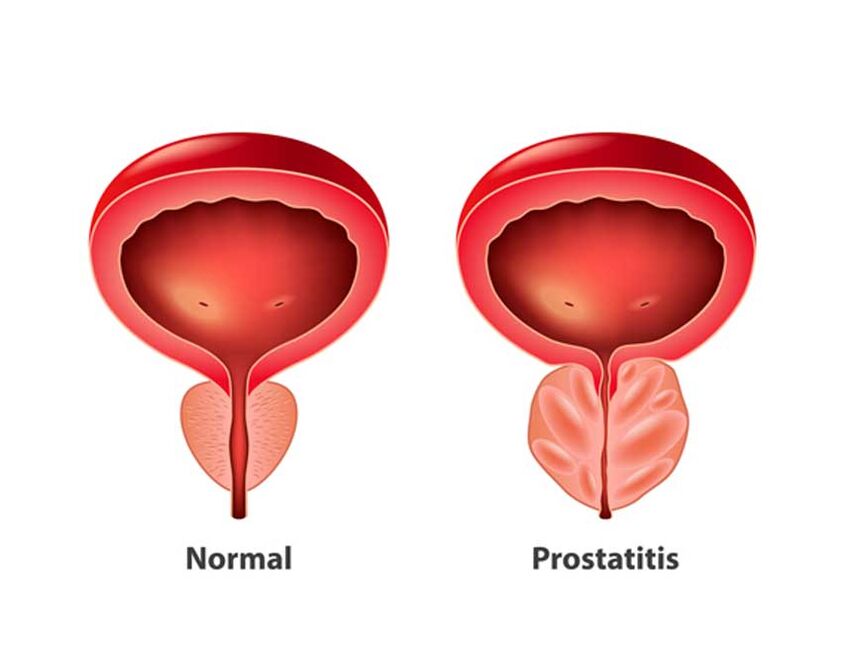 normálna prostata