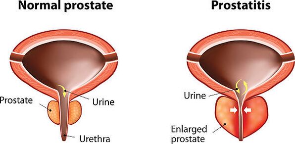 Normálna a zapálená prostata