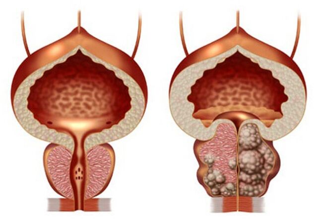 zdravá prostata a adenóm prostaty